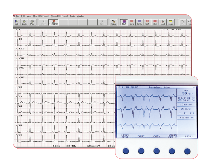 seca Thrombolysis Upgrade